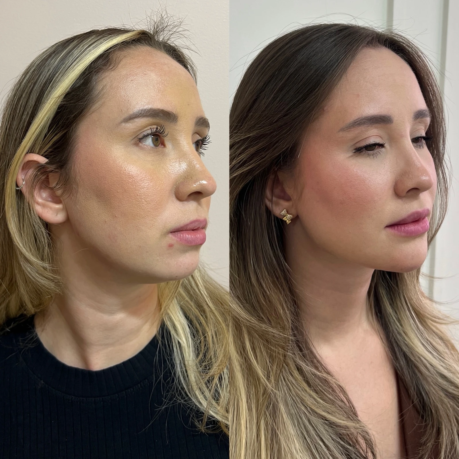 Antes e depois — resultado 04