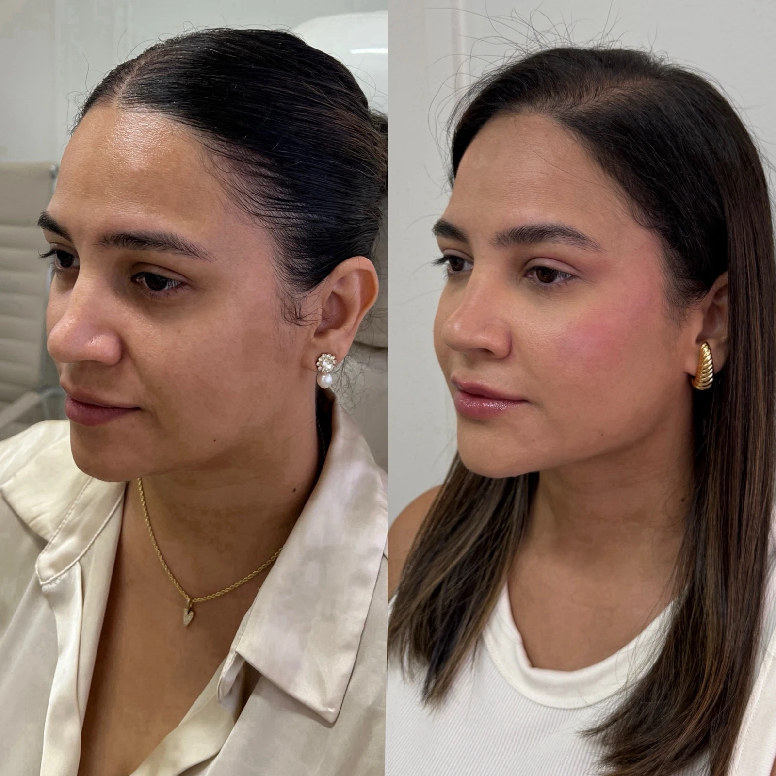 Antes e depois — resultado 05